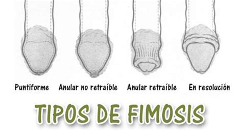 postoperatorio circuncisin fotos|Recuperación tras Fimosis, antes y después